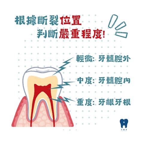 門牙掉了多久會長|門牙斷掉/脫落怎麼辦？3步驟拯救脫落的牙齒，1狀況。